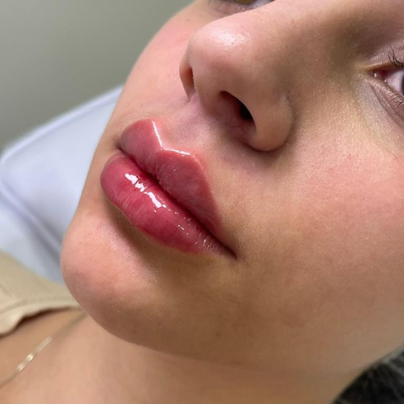 Preenchimento labial — resultado