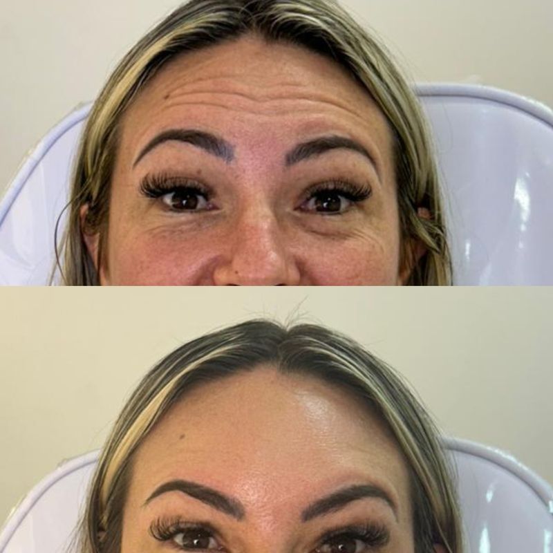 Toxina botulínica — antes e depois