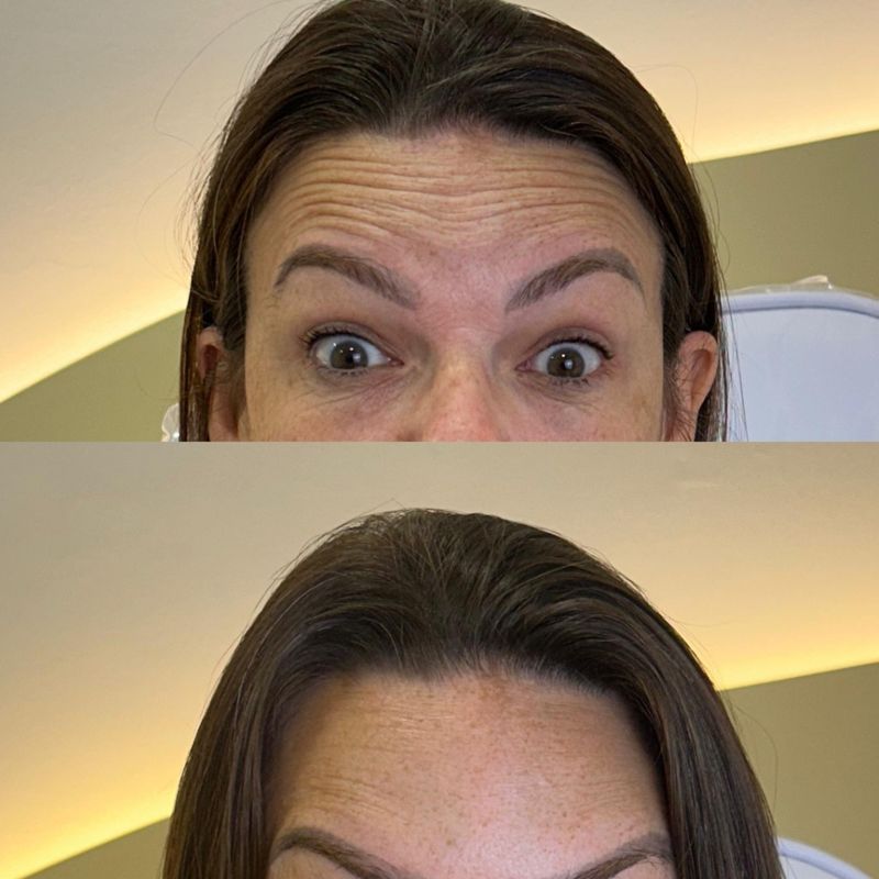 Toxina botulínica testa — antes e depois