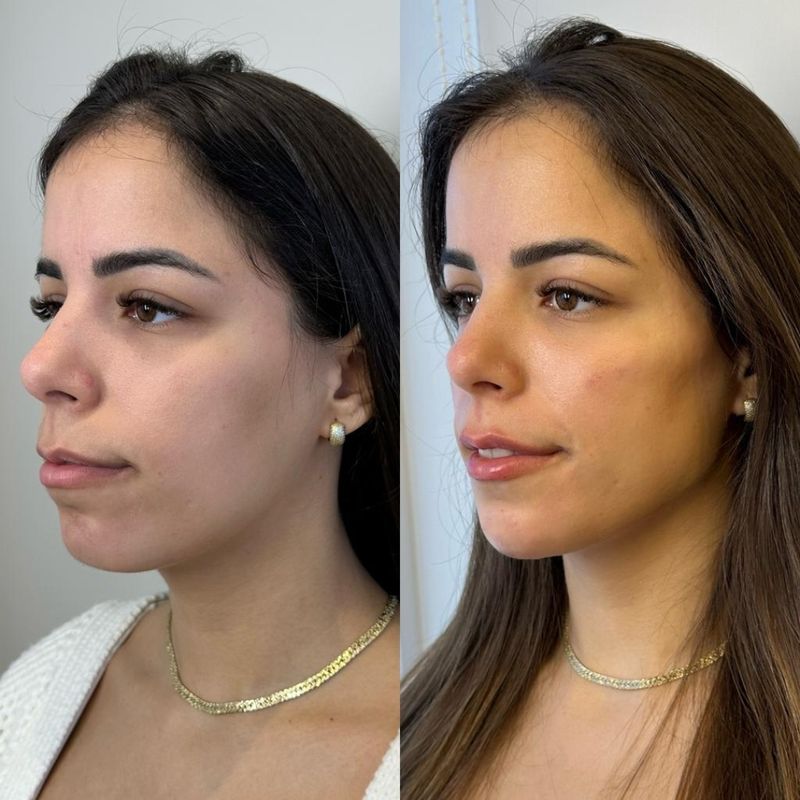 Harmonização facial — antes e depois