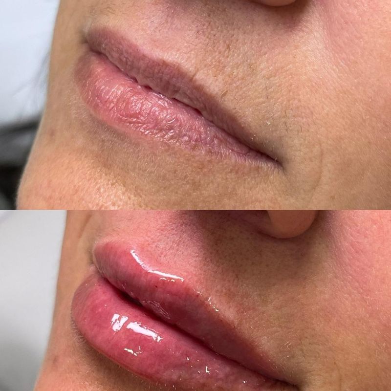 Preenchimento labial — antes e depois