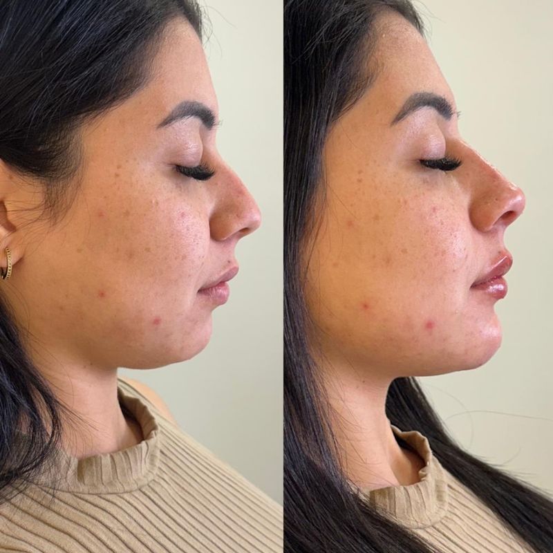 Rinomodelação perfil — antes e depois